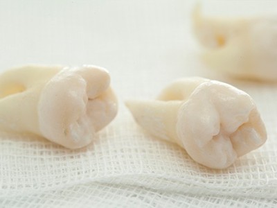 智齒疼了，這牙非拔不可嗎？