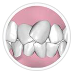 牙齒擁擠 牙齒擁擠