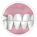 前牙反頜 前牙反頜