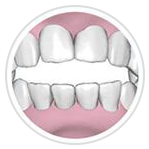 牙齒開頜 牙齒開頜