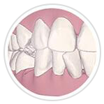 牙齒排列不齊 牙齒排列不齊