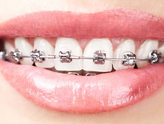 傳統(tǒng)托槽矯正 傳統(tǒng)托槽矯正