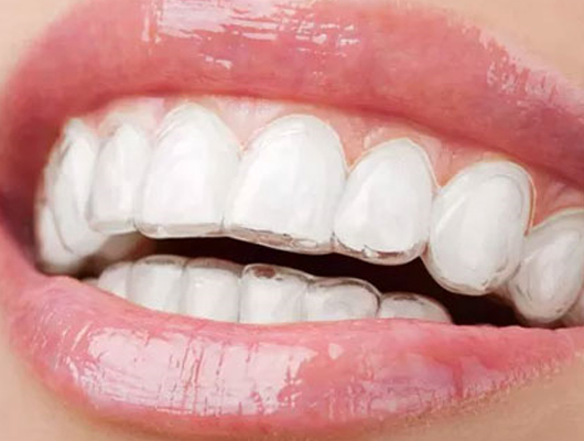 隱形矯正 隱形矯正