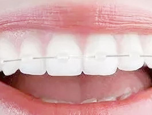 陶瓷矯正 陶瓷矯正