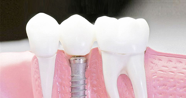 在承德口腔種植牙齒需要多少錢？惟德口腔一一為您道來